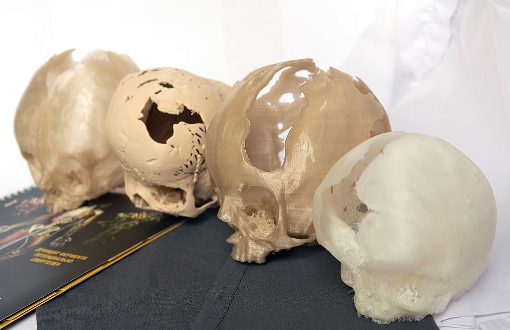 Виртуальное моделирование и создание 3D-макетов черепов с дефектами развития – важнейшие инновации в нейрохирургии.