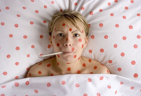 Корь: как спастись