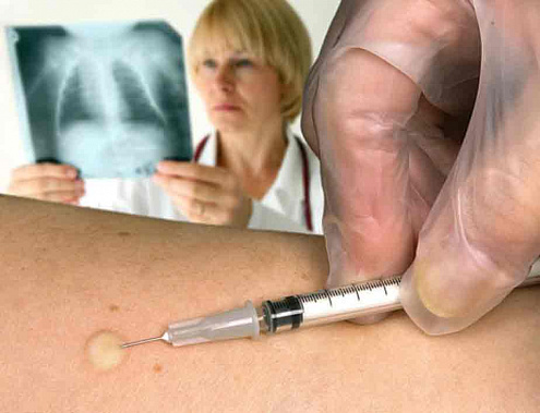 Бессмысленные споры вокруг пробы Манту