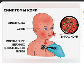 На Дону сохраняется тенденция к росту заболеваемости корью