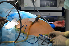 11 07 2025 Донские врачи прооперировали онкобольного с помощью лапароскопии