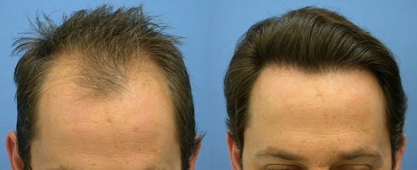 Метод FUE? Follicular Units Extraction, пересадка волос, без швов, без рубцов, клиника, Украина, Киев, Лазер Оне, Laser One