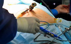 11 07 2025 Донские врачи прооперировали онкобольного с помощью лапароскопии