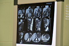 11 07 2025 Донские врачи прооперировали онкобольного с помощью лапароскопии