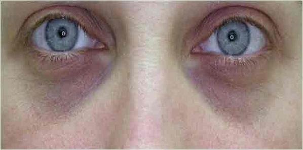 Если тени залегли под глазами