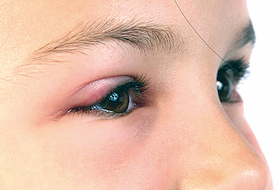 Если комар укусил в веко…