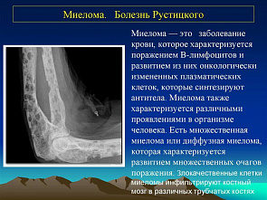 Ростовские врачи добились выраженной ремиссии пациента с миеломой III стадии
