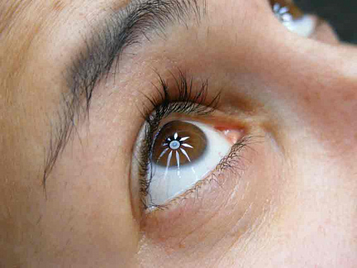 Вместо капель – глазной имплант 