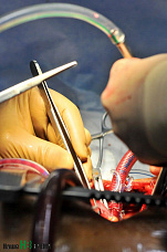 Трансплантология набирает обороты